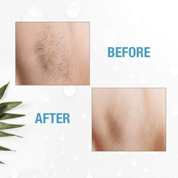 Clean + Easy Non-Laser Personal Electrolysis Device - Permanent Hair - Image 5