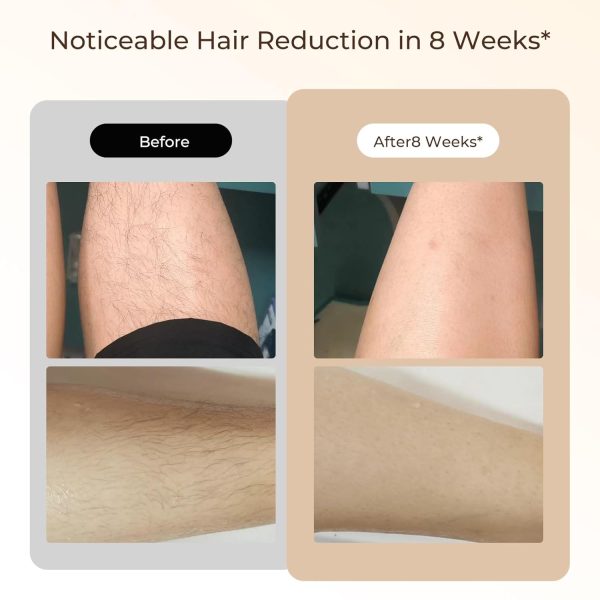 Laser Hair Removal, Laser IPL Hair Removal for Woman and Men Permanent, - Image 6