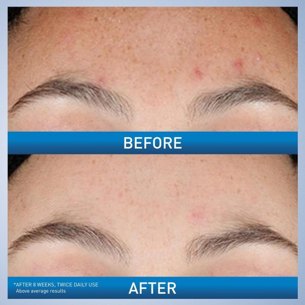 CeraVe Resurfacing Retinol Serum For Post Acne Marks, Formulated With - Image 3