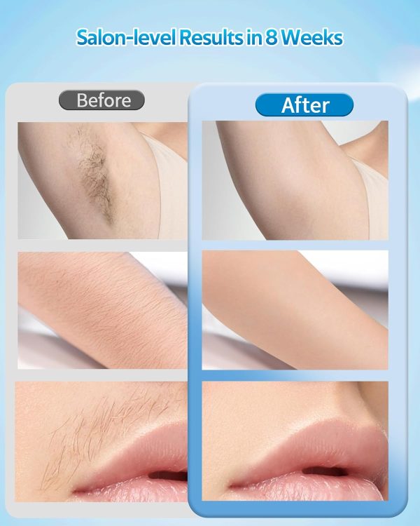 TMOMT OPT Laser Hair Removal Device Permanent, At Home IPL Hair Removal Pro - Image 6