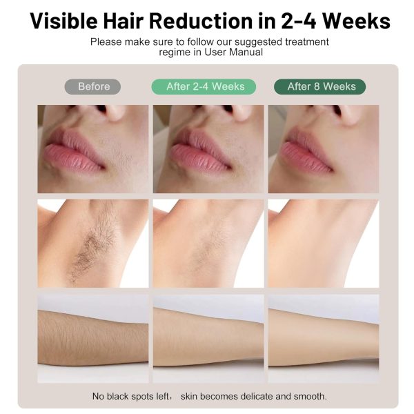 Laser Hair Removal Device, IPL Hair Removal Device with Ice Cooling Care, - Image 2