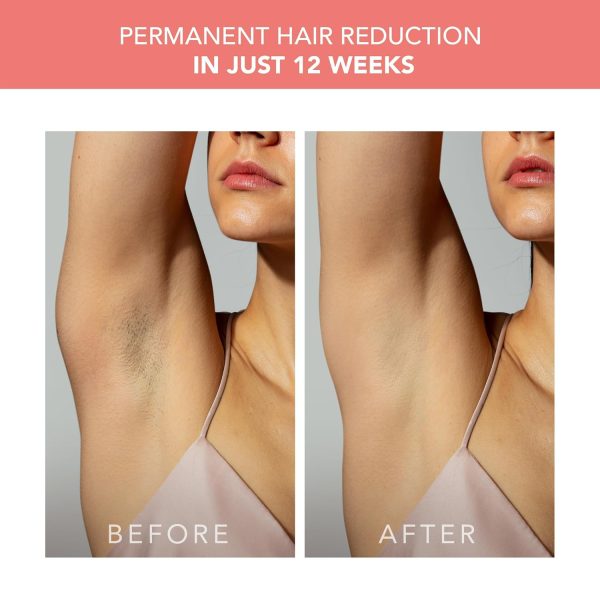 FOREO PEACH 2 IPL Hair Removal Device - Fast & Pain free Permanent Hair - Image 5