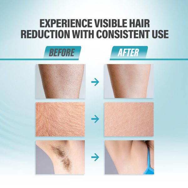 Herbishh IPL Laser Hair Removal Device, Painless Cooling Technology- - Image 6