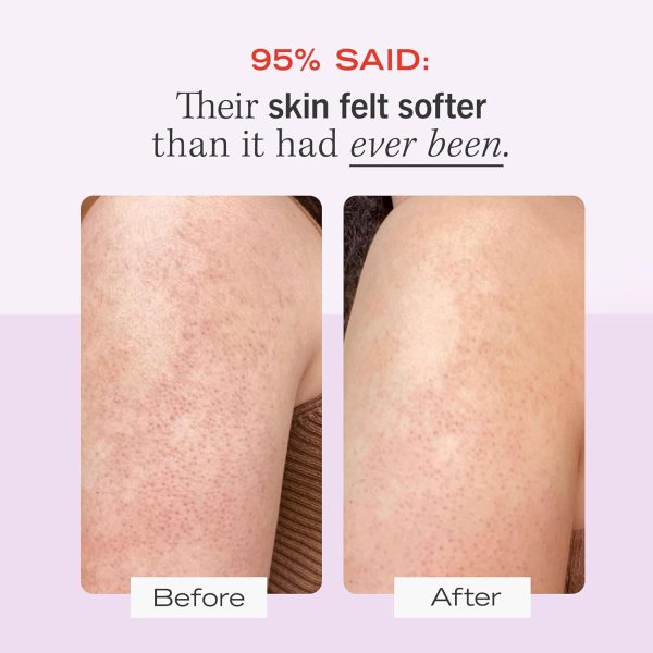 First Aid Beauty - KP Bump Eraser Body Scrub with 10% AHA, Keratosis - Image 3
