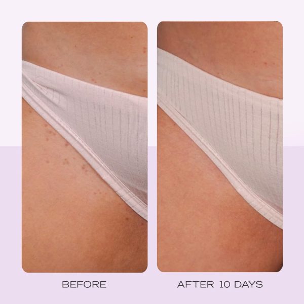 First Aid Beauty - Ingrown Hair Pads with BHA + AHA - Afterhsave Treatment - Image 5