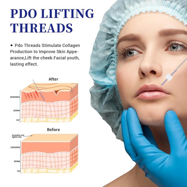 PDO Mono Thread, Pdo Threads Stimulate Collagen Production to Improve Skin - Image 5