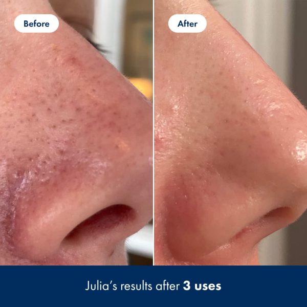 Hero Cosmetics Pore Release Blackhead Clearing Solution - Exfoliating Toner - Image 5