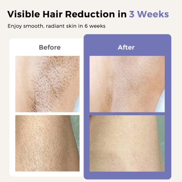 Laser Hair Removal Device Cordless, Painless & Permanent, 3 Weeks Faster - Image 6