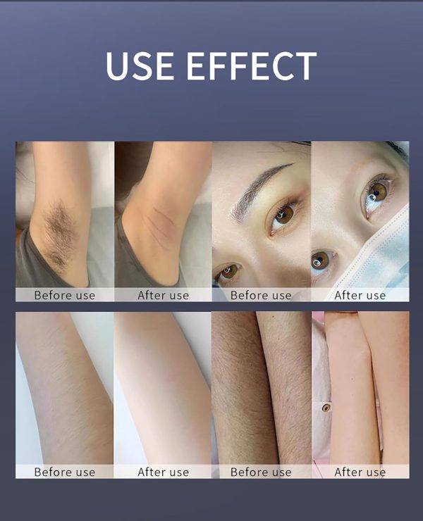Men Women Permanent Laser Facial Hair Removal Device，755nm 808nm 1064nm - Image 6