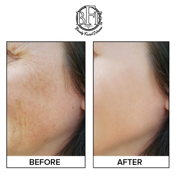 Anti Aging Resurfacing Exfoliating Peel Pads Treatment- Contains Lactic, - Image 4