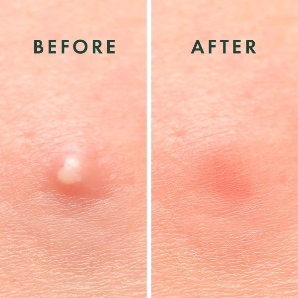 Rael Pimple Patches, Miracle Invisible Spot Cover - Hydrocolloid Acne Patch - Image 6