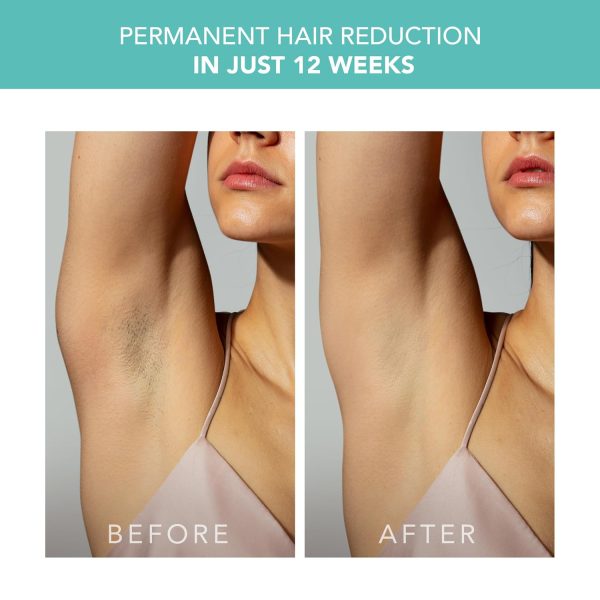 FOREO PEACH 2 IPL Hair Removal Device - Fast & Pain free Permanent Hair - Image 5