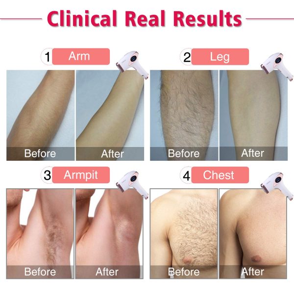 Permanent Hair Removal for Women & Men, IMENE 500,000 Flashes IPL Permanent - Image 3