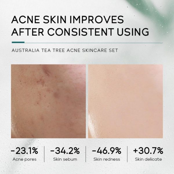 Skin Care Set,Acne Treatment for Face Skin Care Sets & Kits,Tea Tree - Image 4