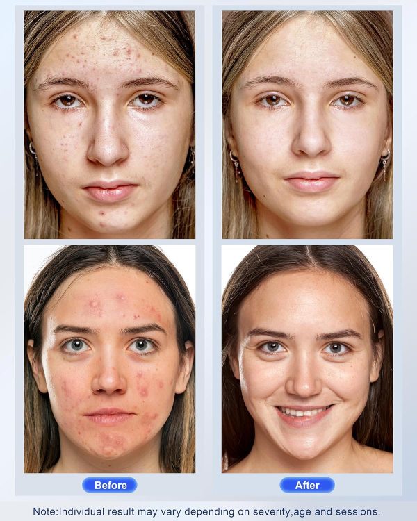Red Light therapy Mask for Face Wrinkles,Blue Light therapy for Face - Image 3