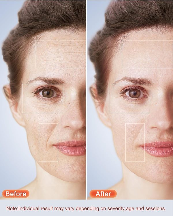 Red Light therapy Mask for Face Wrinkles,Blue Light therapy for Face - Image 2