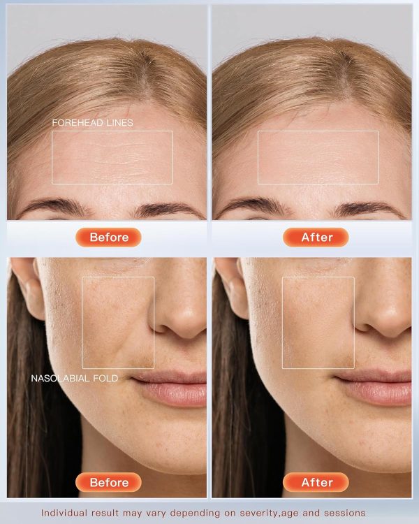 NEWKEY LED Face Mask Light Therapy,Red Light Therapy for Face Wrinkle Blue - Image 3